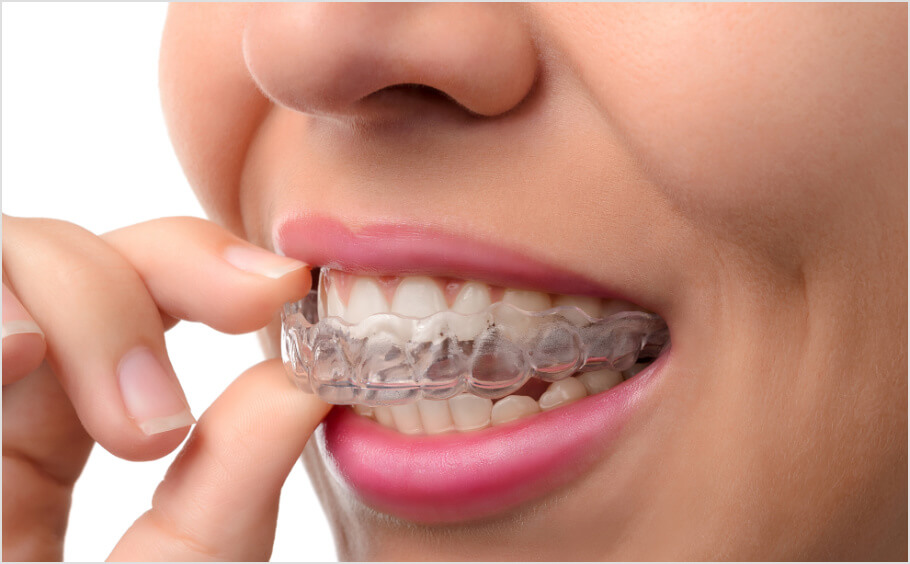 Straight-Teeth